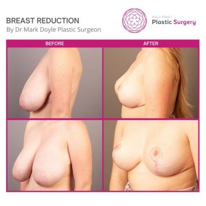 breast reduction photos before after plastic surgery