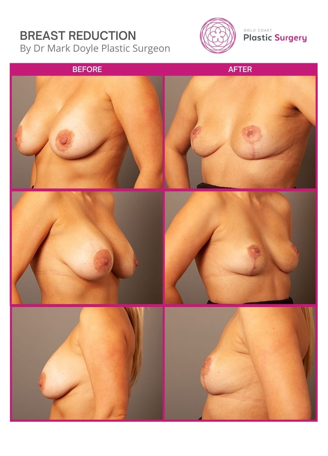 breast reduction surgery before after images