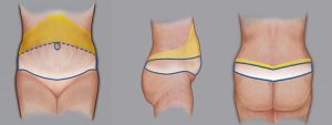 circumferential abdominoplasty after massive weight loss
