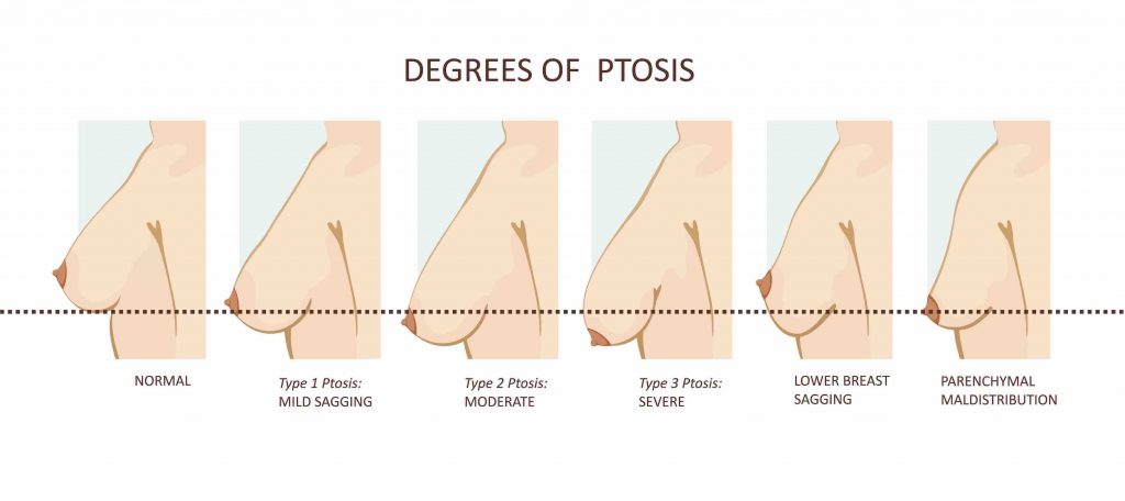 degrees of ptosis breast sagging