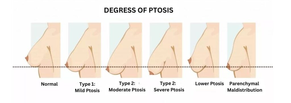 degrees of breast ptosis 