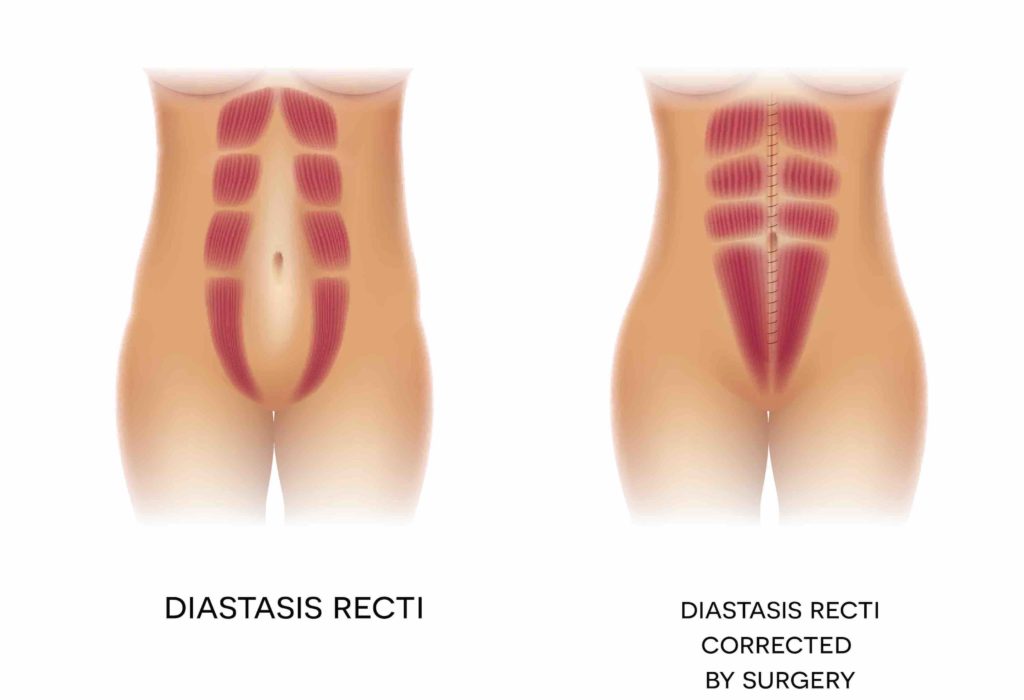 diatasis recti surgery cost australia