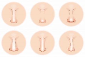different nose shapes to fix with surgery