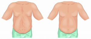 removal of excess skin after weight loss belt lipectomy procedure northern rivers