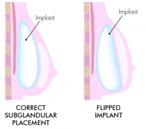 flipped breast implant