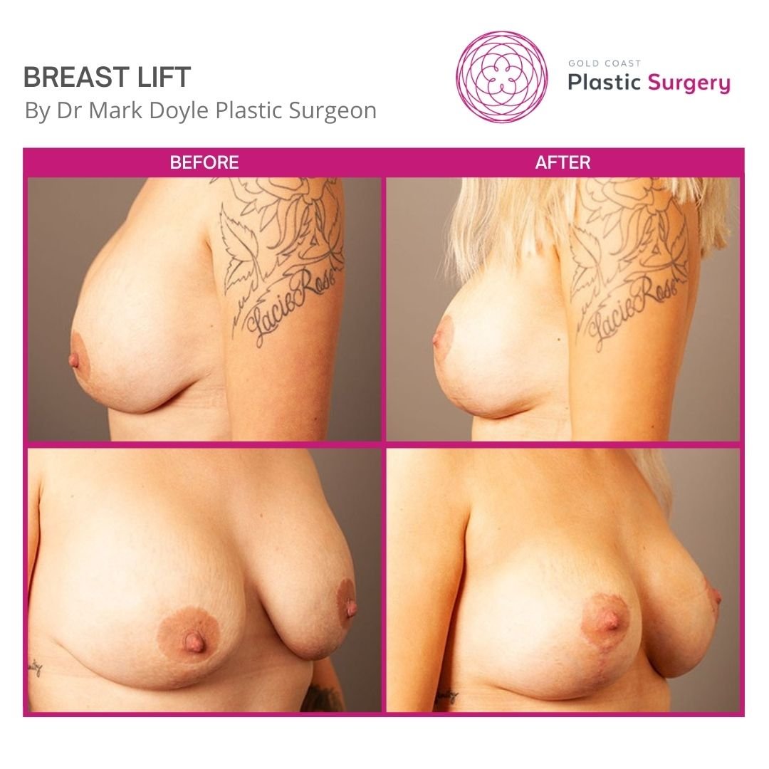 images of breast lift cosmetic surgery