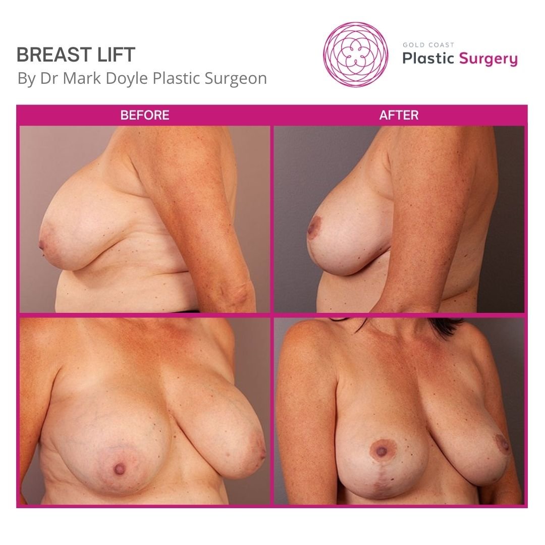 images of breast lift plastic surgery
