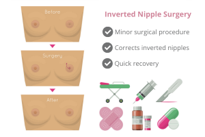 inverted nipple surgery cosmetic surgeon new south wales queensland