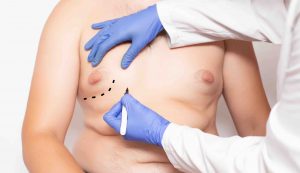 male breasts treatment options plastic surgery brisbane northern rivers nsw