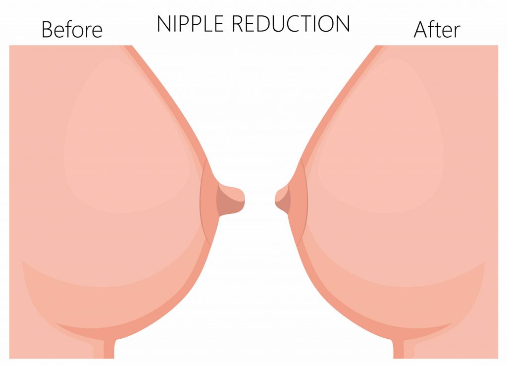 Nipple Reshaping Areola Nipple Surgery What To Expect Gcps