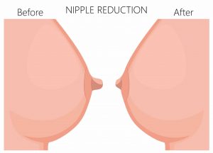 nipple reduction before and after plastic surgery brisbane