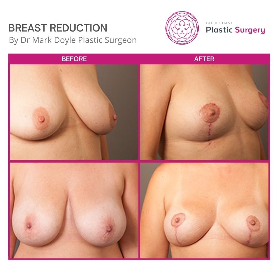 breast reduction australia