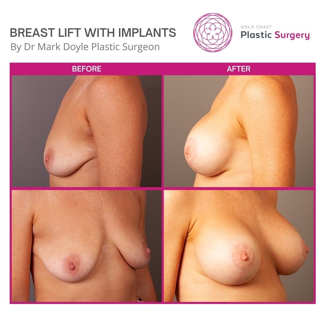 real patient images breast lift and implants