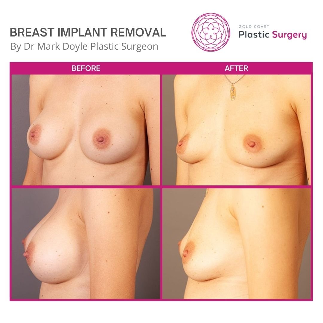removal of breast implants before and after photos