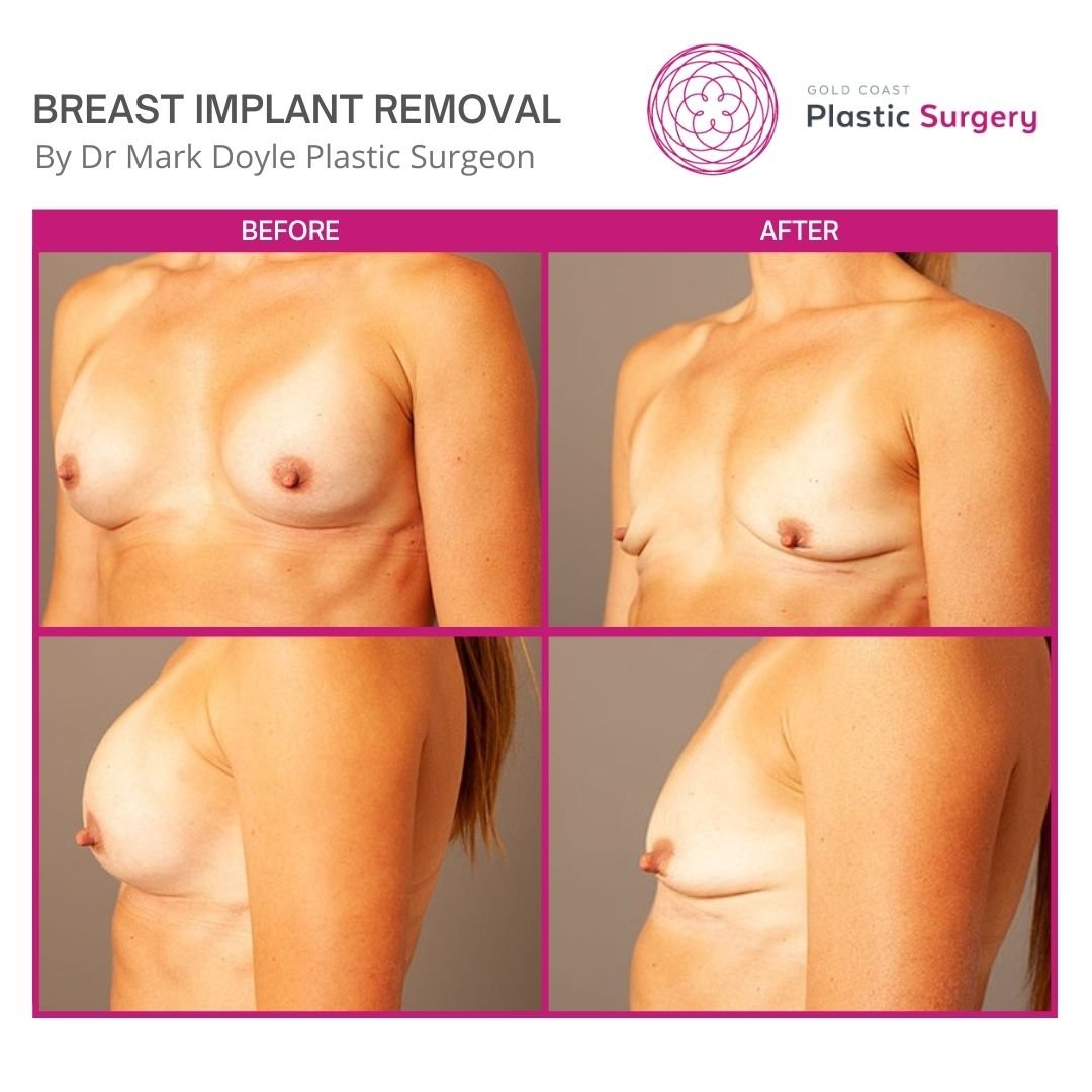 remove implants before and after photos