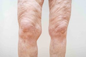 thigh wedge excision cosmetic surgeon brisbane queensland