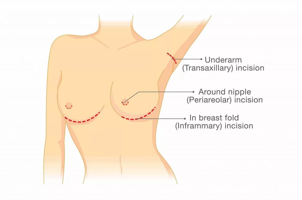 5 Ways to Get Natural-Looking Breasts