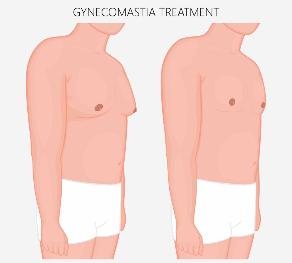 what to expect before and after man boob surgery