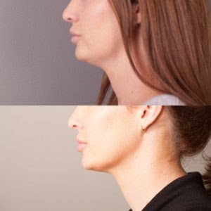 belkyra double chin fat dissolving injections