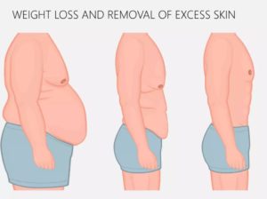 loose skin after losing weight