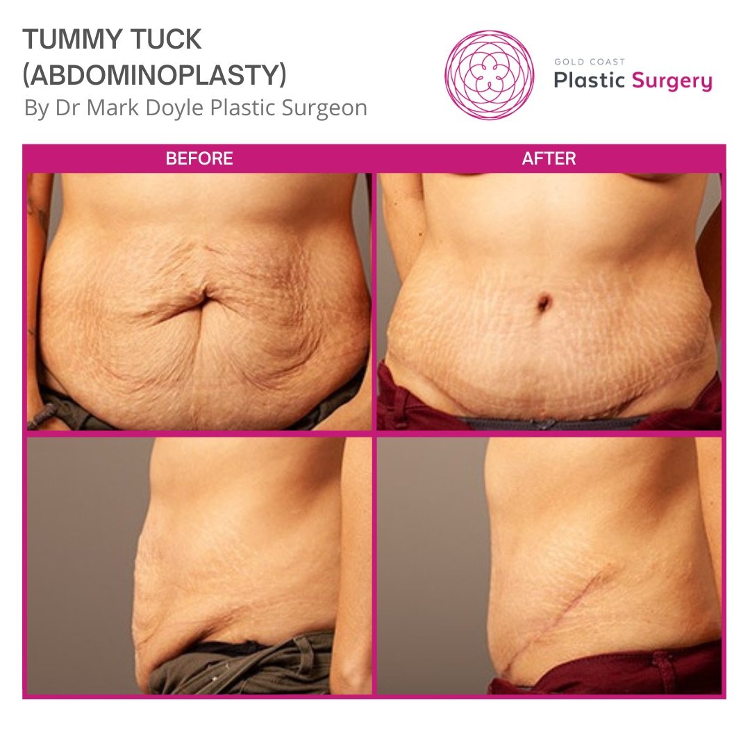 tummy tuck before and after pregnancy