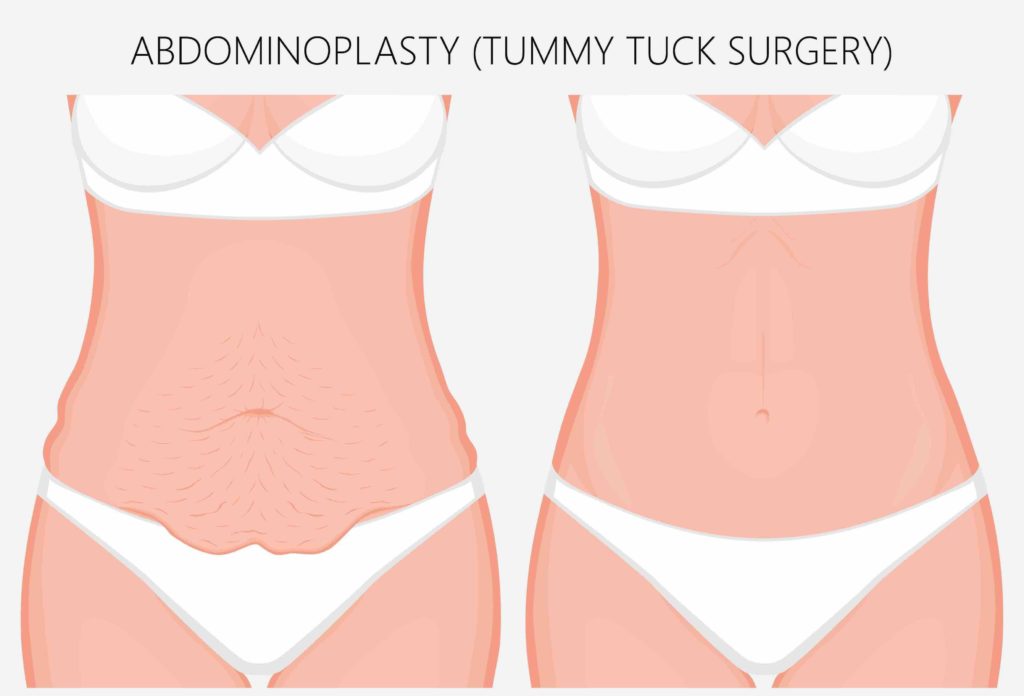 what is tummy tuck