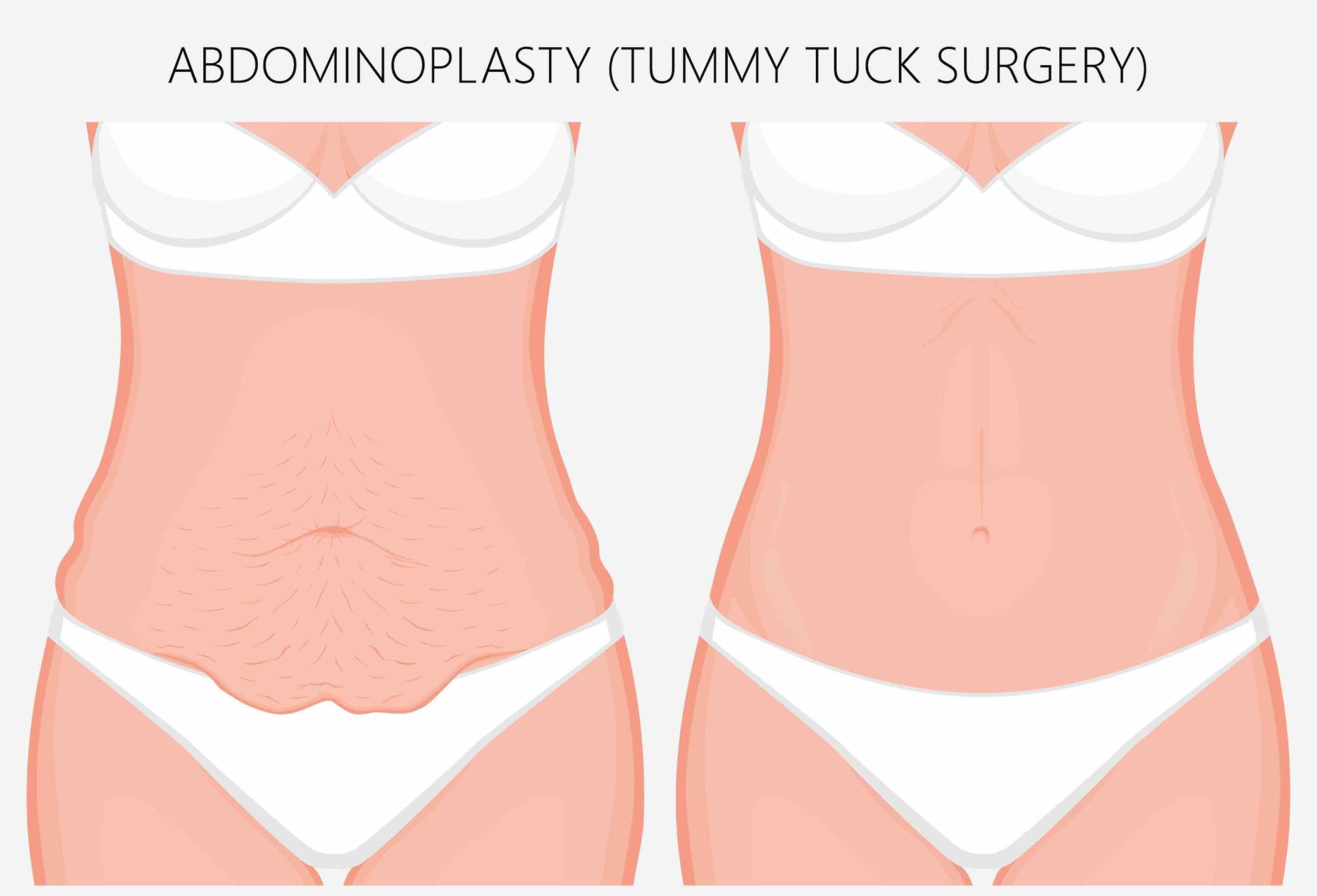Tummy Tuck Abdominoplasty Dr Mark Doyle