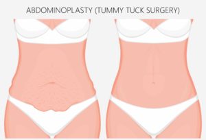 tightened muscle as a result of tummy tuck
