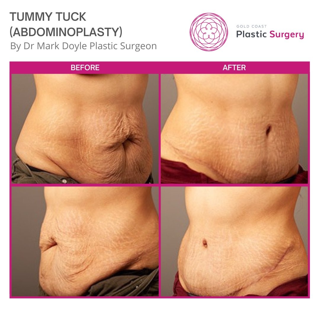 tummy tuck before and after brisbane