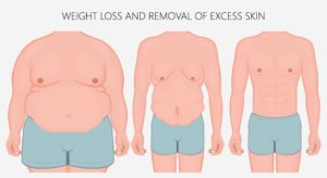 weight loss and the removal of excess skin
