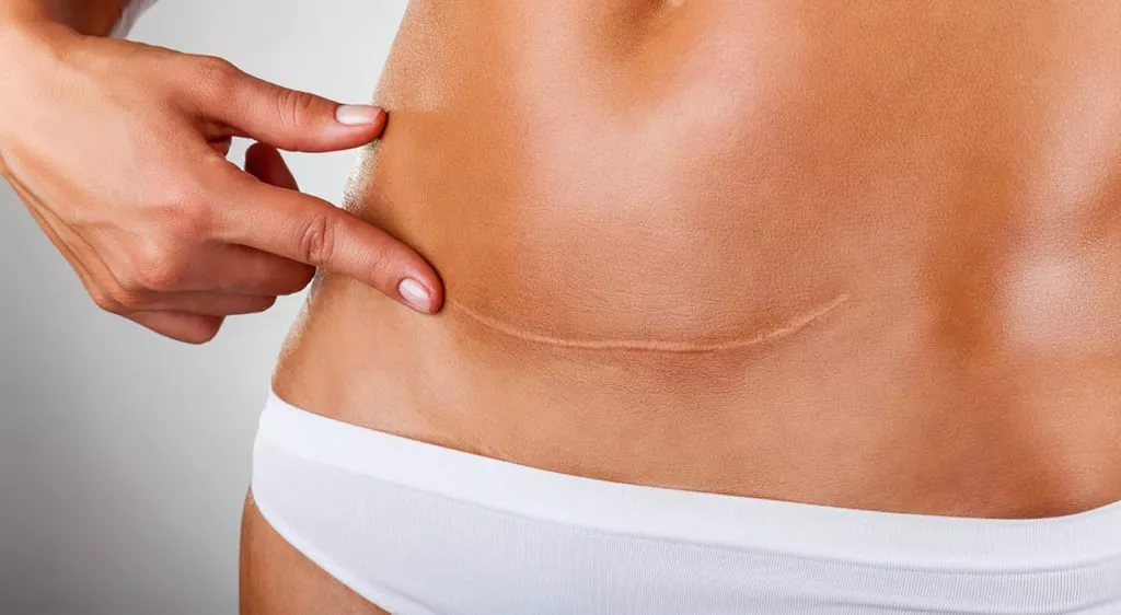 how to fix tummy tuck dog ears