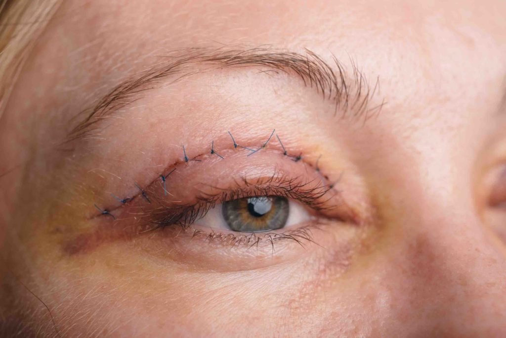 blepharoplasty surgery recovery