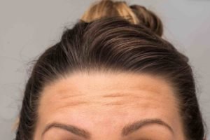 botox gold coast forehead lines