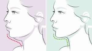chin liposuction for sagging jowls
