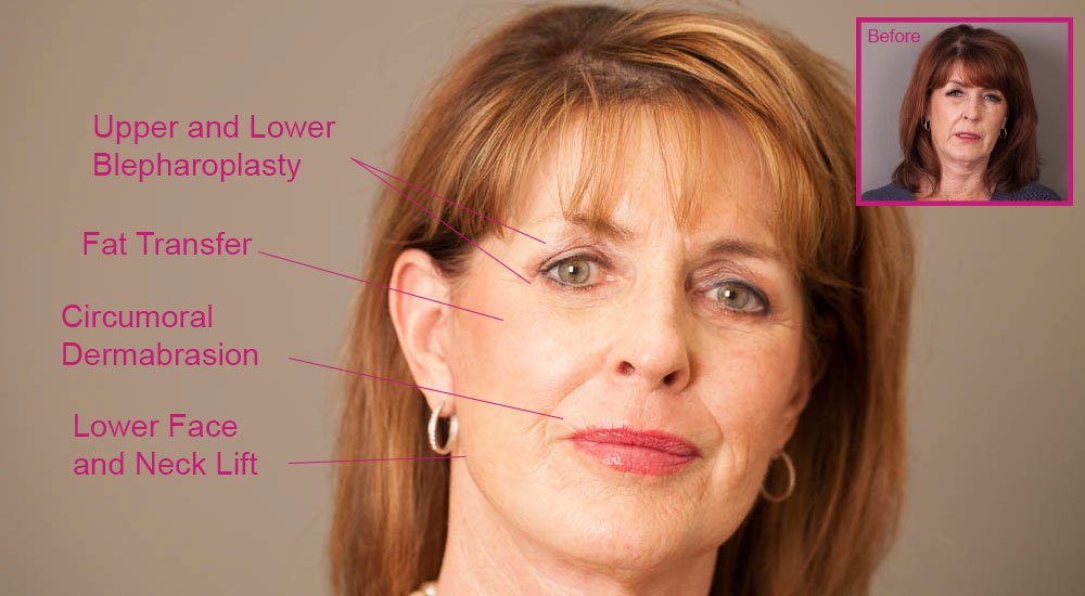 surgery for sagging jowls 