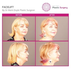 face and neck lift images
