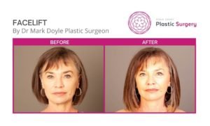 face and neck lift images