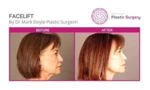 full face and neck lift surgery