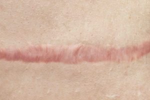 how to prevent keloid scars