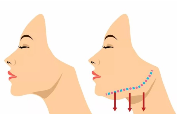 how to reduce cheek laxity