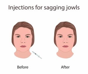 reduce jowls without surgery
