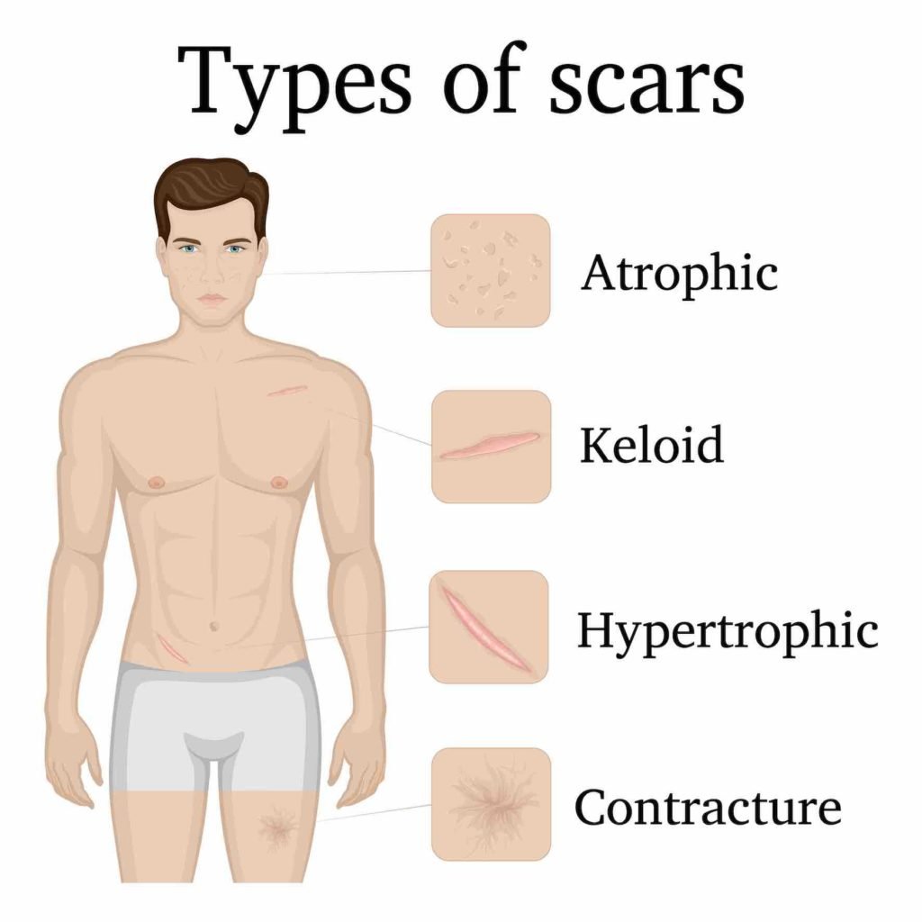 scar types