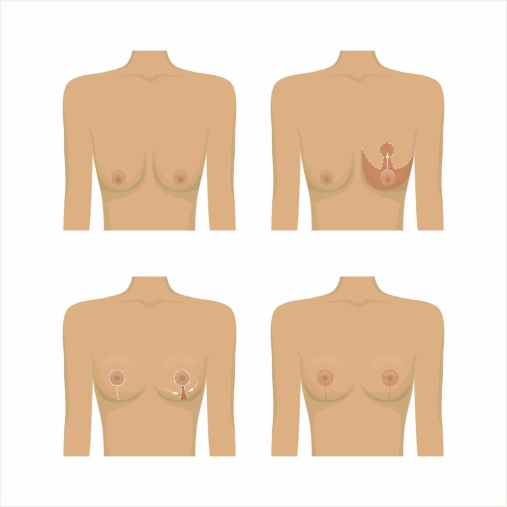 breast lift scars