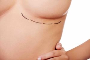 where are breast reduction scars