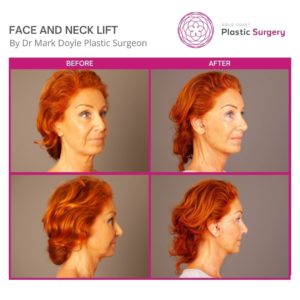 full face and neck lift