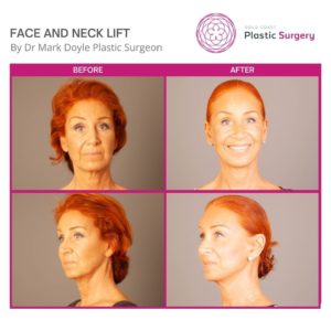 face and neck lift pics