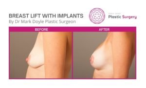 breast lift with implants pics