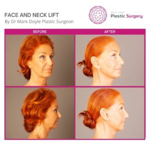full face and neck lift