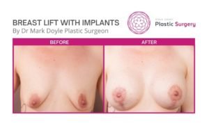 breast lift with implant surgery