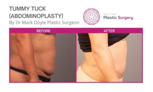 abdominoplasty surgery results